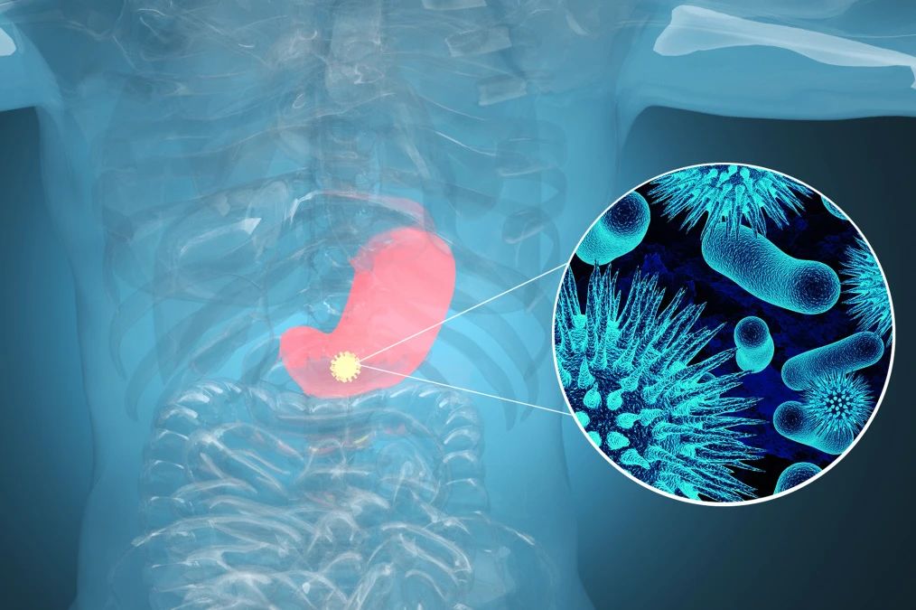 肿瘤标记物CA72-4：“胃”，你还好吗？